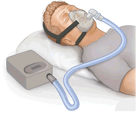 Continuous positive airway pressure (CPAP) is a form of positive airway pressure ventilator, which applies mild air pressure on a continuous basis to keep the airways continuously open in people who are not able to breathe spontaneously on their own.